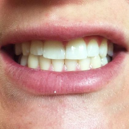 image of man with restorative dentistry